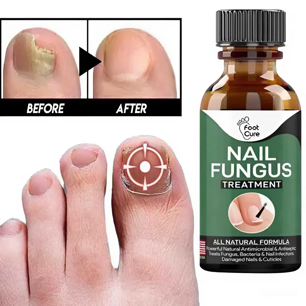 Zylo - Nail Fungal Repair Serum | Nail Fungus Removal Gel