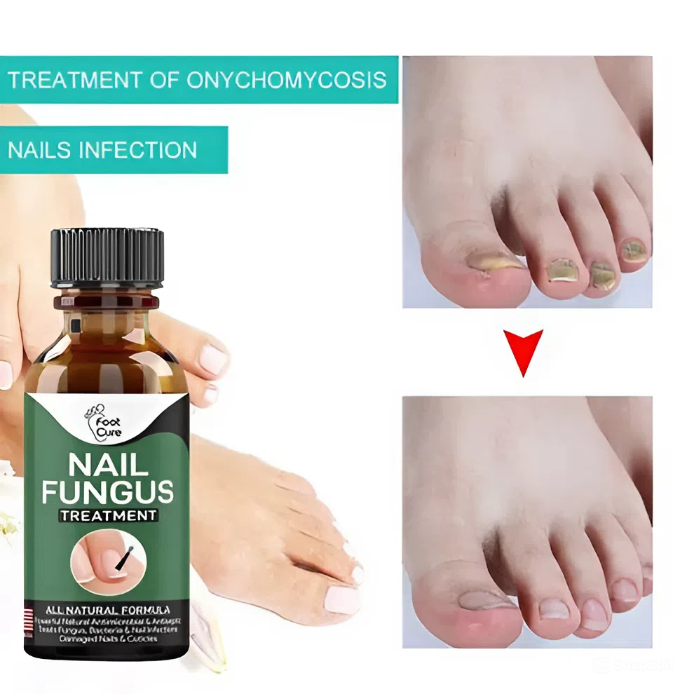 Zylo - Nail Fungal Repair Serum | Nail Fungus Removal Gel